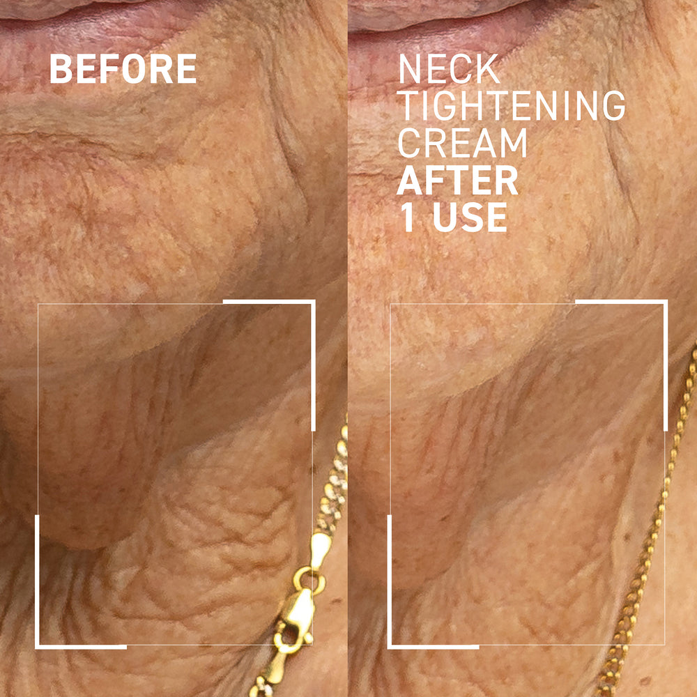 NEEDLES NO MORE <br> NECK TIGHTENING CREAM 2.0