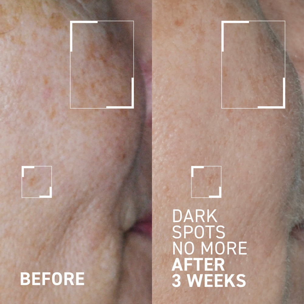 BRIGHT THIS WAY <br> DARK SPOTS NO MORE®